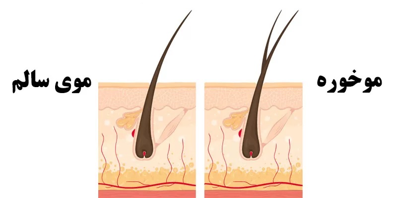 انواع موخوره مو