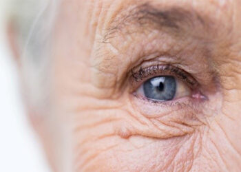 درمان‌های خانگی چروک دور چشم