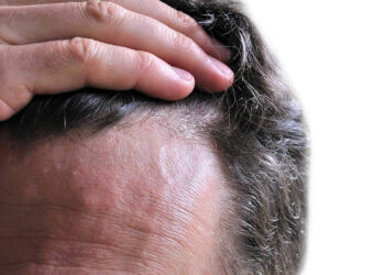 ساده‌ترین روش‌ها برای درمان شوره سر