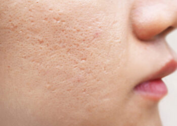 درمان معجزه آسای منافذ باز پوست