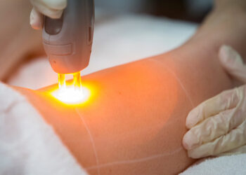 لیزر موی زائد