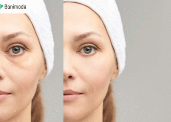 بهترین روش‌های از بین بردن گودی زیر چشم