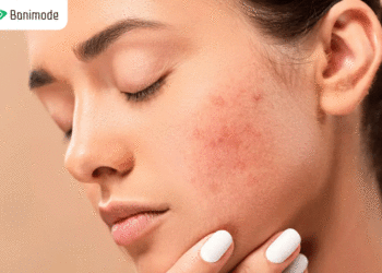 درمان آکنه