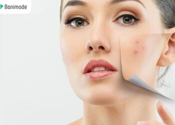 راهنمای خرید کرم ضد جوش: انتخاب هوشمندانه برای پوستی سالم