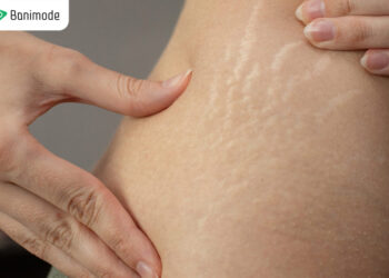 ترک پوستی چیست؟ روش های خانگی و پزشکی رفع ترک پوستی