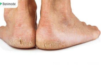 درمان ترک پا | راهنمای کامل جلوگیری و درمان