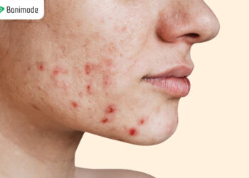 انواع جوش صورت و بدن